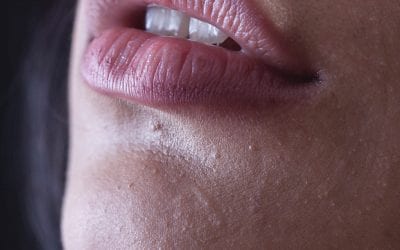 Is Filler Safe?